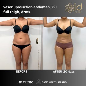 Résultats avant/après liposuccion VASER 360 abdomen, cuisses, bras à ID Clinic Bangkok