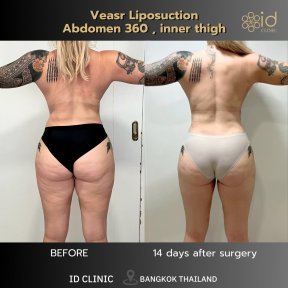 Résultats avant et après liposuccion VASER abdomen 360 et cuisse interne à ID Clinic Bangkok