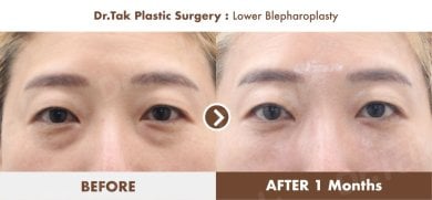 Lower blepharoplasty before and after results at Dr. Tak Plastic Surgery, reduced eye bags