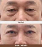 Facelift before and after results at Dr. Tak Plastic Surgery – reduced wrinkles and firmer skin