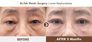 Lower blepharoplasty before and after results at Dr. Tak Plastic Surgery, reduced eye bags