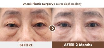 Lower blepharoplasty before and after results at Dr. Tak Plastic Surgery, reduced eye bags