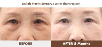 Lower blepharoplasty before and after results at Dr. Tak Plastic Surgery, reduced eye bags