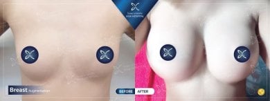 Vorher-nachher-Ergebnisse Brustimplantat-Revision bei Asia Cosmetic Hospital, verbesserte Form