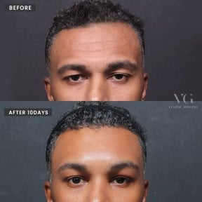 Facelift before and after results at VG Plastic Surgery – visible facial rejuvenation after 10 days
