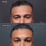 Facelift before and after results at VG Plastic Surgery – visible facial rejuvenation after 10 days