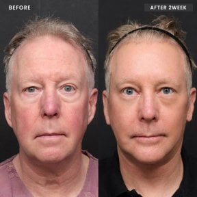 Facelift before and after results at VG Plastic Surgery – visible facial rejuvenation in 2 weeks