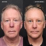 Facelift before and after results at VG Plastic Surgery – visible facial rejuvenation in 2 weeks
