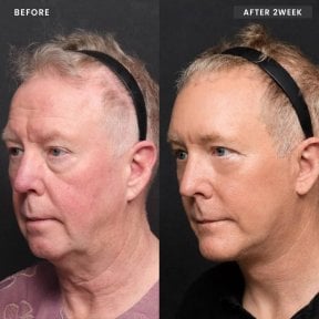 Facelift before and after results at VG Plastic Surgery – visible facial rejuvenation after 2 weeks