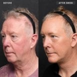 Facelift before and after results at VG Plastic Surgery – visible facial rejuvenation after 2 weeks
