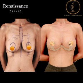 Before and after mammoplasty results at Renaissance Clinic, visible breast shape improvement