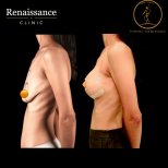 Before and after mammoplasty results at Renaissance Clinic – visible breast augmentation outcome