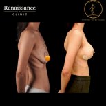 Before and after mammoplasty results at Renaissance Clinic – visible breast augmentation outcome