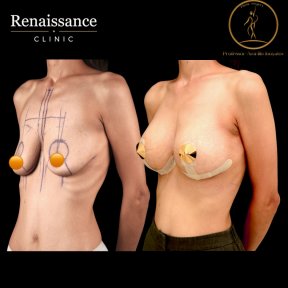 Before and after mammoplasty results at Renaissance Clinic, visible breast augmentation outcome