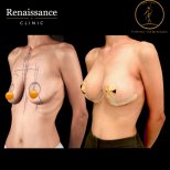 Before and after mammoplasty results at Renaissance Clinic, visible breast augmentation outcome