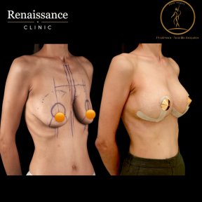 Before and after mammoplasty results at Renaissance Clinic, visible breast lift and contour