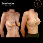Before and after mammoplasty results at Renaissance Clinic, visible breast lift and contour