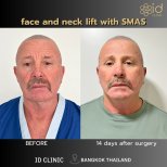 Avant/après lifting visage et cou SMAS à ID Clinic Bangkok, résultat rajeunissant visible