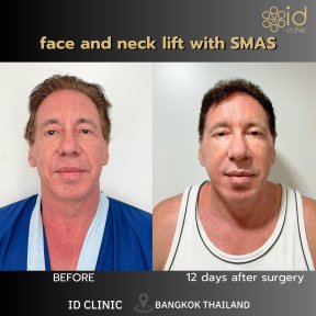 Résultats avant/après lifting visage et cou SMAS à ID Clinic Bangkok, 12 jours post-op