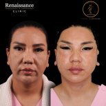 Facelift before and after results at Renaissance Clinic, visible facial rejuvenation outcome