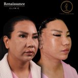 Before and after facelift results at Renaissance Clinic, visible facial contour improvement