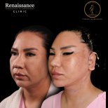 Facelift before and after results at Renaissance Clinic, visible facial rejuvenation and lift
