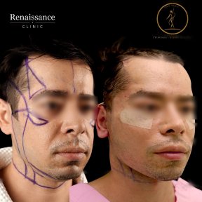Facelift before and after results at Renaissance Clinic, visible facial contour improvement