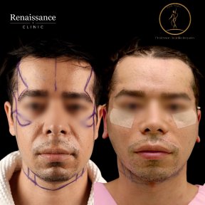 Facelift before and after results at Renaissance Clinic, visible facial contour improvement