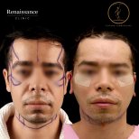 Facelift before and after results at Renaissance Clinic, visible facial contour improvement
