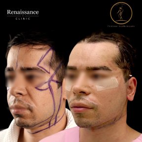 Facelift before and after results at Renaissance Clinic, visible facial contour improvement