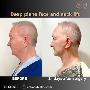 Résultats avant/après lifting visage et cou deep plane à ID Clinic Bangkok, 14 jours post-op