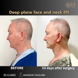 Résultats avant/après lifting visage et cou deep plane à ID Clinic Bangkok, 14 jours post-op