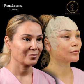 Facelift before and after results at Renaissance Clinic – visible facial rejuvenation outcome