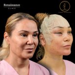 Facelift before and after results at Renaissance Clinic – visible facial rejuvenation outcome