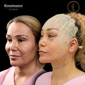 Facelift before and after results at Renaissance Clinic, visible facial rejuvenation outcome