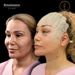 Facelift before and after results at Renaissance Clinic, visible facial rejuvenation outcome