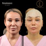 Facelift before and after results at Renaissance Clinic, visible facial rejuvenation outcome