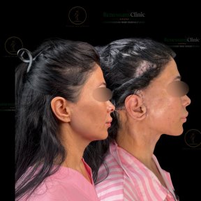 Facelift before and after results at Renaissance Clinic, visible facial contour improvement