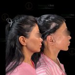 Facelift before and after results at Renaissance Clinic, visible facial contour improvement