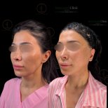 Facelift before and after results at Renaissance Clinic, visible facial contour improvement