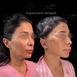 Facelift before and after results at Renaissance Clinic – visible facial contour improvement