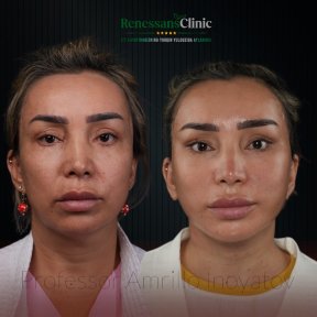 Facelift before and after results at Renaissance Clinic, visible facial rejuvenation outcome
