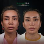Facelift before and after results at Renaissance Clinic, visible facial rejuvenation outcome