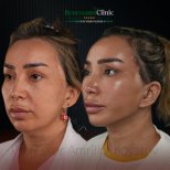 Facelift before and after results at Renaissance Clinic – visible facial rejuvenation outcome