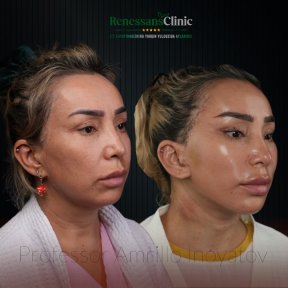 Facelift before and after results at Renaissance Clinic, visible facial contour improvement