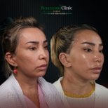 Facelift before and after results at Renaissance Clinic, visible facial contour improvement