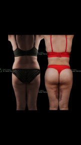 Before and after full body lift results at Renaissance Clinic, visible body contour improvement