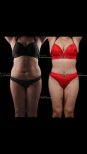 Before and after full body lift results at Renaissance Clinic, improved body contour visible