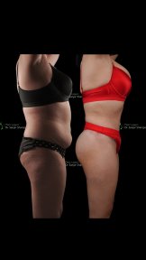 Before and after full body lift results at Renaissance Clinic, improved body contour visible