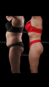 Before and after full body lift results at Renaissance Clinic – improved body contour visible